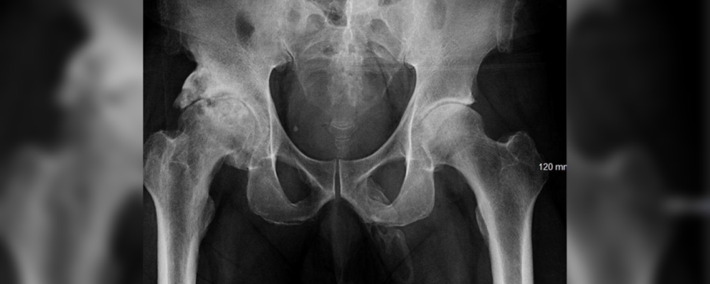 Osificación del pene web